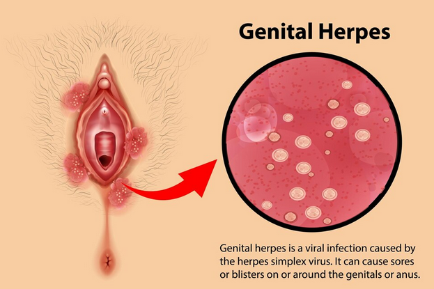 أعراض مرض الهربس التناسلي